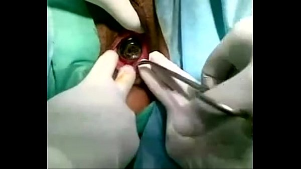 how to reject a GLASSY BULB from vagina!